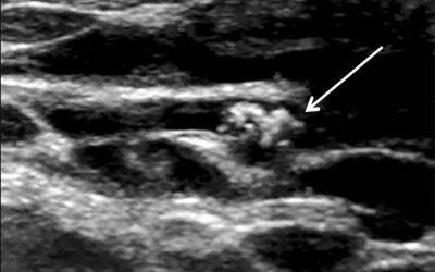 Gray-scale breast ultrasound image shows intraductal calcifications (arrow). Read more. Image courtesy of RSNA. What do breast microcalfifications look like on ultrasound? Examples of breast imaging, mammograophy imaging.