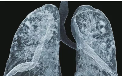 A three-dimensional rendering of a CT scan shows densely consolidated inflammation caused by COVID-19, which NYU Langone radiologists have linked to poor outcomes. Image courtesy of Matthew Young, DO, clinical assistant professor of radiology. What does COVID look like in the lungs?