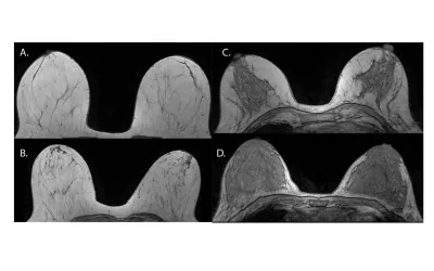 Mammographic density translates into fibroglandular tissue quantity. These examples show what breast density looks like on MRI imaging. Axial nonenhanced T1-weighted MR images show the following descriptors: A. almost entirely fat, B. scattered fibroglandular tissue, C. heterogeneous fibroglandular tissue, and D. extreme fibroglandular tissue. RSNA Images. What do dense breasts look like on MRI?