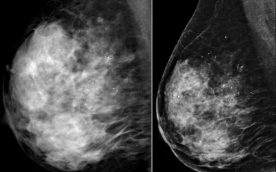 Micro calcifications breast imaging mammogram pre and post chemo_RSNA.jpg