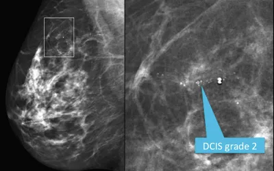Mediolateral oblique view from a screening mammogram in a 54-year-old woman shows a small cluster of microcalcifications in the upper outer quadrant of the right breast. The right image shows a detailed spot magnification view of the calcifications. Stereotactic biopsy revealed grade 2 ductal carcinoma in situ (DCIS). RSNA image. Image of breast micro calcifications associated with breast cancer.
