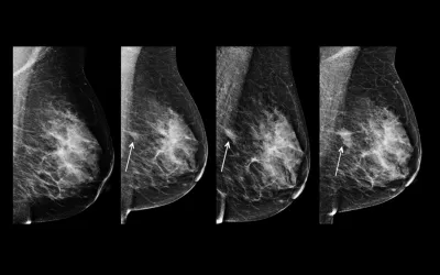 Example of asymmetry in breast imaging. This is a series of mammograms obtained at annual screenings in the same patient are displayed from oldest (far left) to most recent (far right). An asymmetry in the posterior central left breast (arrows) becomes more conspicuous and increases in size over time. The finding carries a 12.8% risk for malignancy when seen at screening mammography and a 26.7% risk for malignancy when it persists at diagnostic mammography.  RSNA images. What is asymmetry in breast imaging