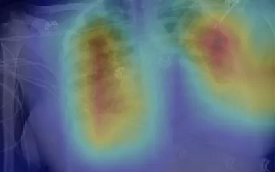 Early on in COVID, Johns Hopkins radiologists used a deep learning algorithm to detect tuberculosis in chest X-rays could be useful for identifying lung abnormalities related to COVID-19. This shows a an overlaid AI heat map of areas of COVID. Chest X-rays were proposed as a potentially useful tool for assessing COVID patients, especially in overwhelmed emergency departments. Image courtesy of Johns Hopkins.