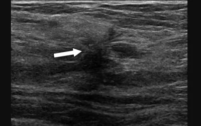 72-year-old woman recalled from screening mammography for architectural distortion (AD) in left breast. Ultrasound of upper outer breast shows irregular hypoechoic mass (arrow) with associated AD at 1-o'clock position. Ultrasound-guided biopsy of revealed malignancy (invasive lobular carcinoma).