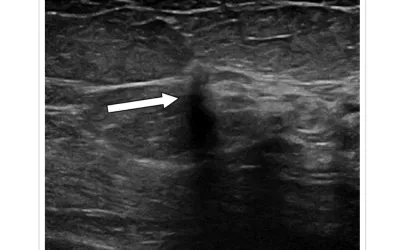 Ultrasound of upper central breast shows irregular hypoechoic mass (arrow) with antiparallel orientation at 12-o'clock position. Ultrasound-guided biopsy of upper central architectural distortion revealed malignancy (invasive ductal carcinoma). 82-year-old woman with history of right mastectomy recalled from screening mammography for architectural distortion (AD) in outer left breast.