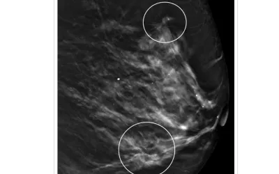 82-year-old woman with history of right mastectomy recalled from screening mammography for architectural distortion (AD) in outer left breast. Left lateral digital breast tomosynthesis (DBT) image shows ADs (circles) in upper central breast and in lower outer breast, consistent with multiple ADs.