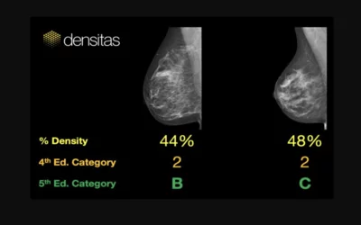 An example of commercially available artificial intelligence (AI) automated grading of breast density on mammograms from the vendor Densitas.. 