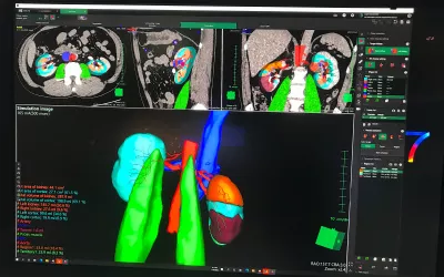 CT kidney analysis software demonstrated by Fujifilm at RSNA 2022. It offers detailed quantification and automation to help speed workflows. #RSNA #RSNA22