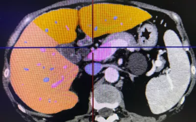 Automated CT liver analysis software demonstrated by Fujifilm at RSNA 2022. It offers detailed quantification and automation to help speed workflows. #RSNA #RSNA22