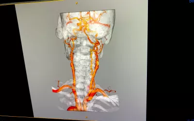 CT reconstruction showing the carotid arteries in the neck on the Intelerad enterprise imaging system. It is a multi-modaility viewer system, so any modality and any types of reconstructed images can be shown in the same view without the need to go to another workstation. #RSNA22