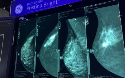 Contrast-enhanced mammography can help confirm a cancer or dismiss a false positive diagnosis while the patient is still at a women’s imaging center. This case displayed by GE shows a clear spiculated cancer mass on the contrast-enhanced images, but dense breast tissue hides the actual extent of the the tumor on the mammogram. Find out more in the VIDEO: Why contrast enhance mammography might be the ideal supplemental imaging - interview with Connie Lehman, MD, at Mass General.