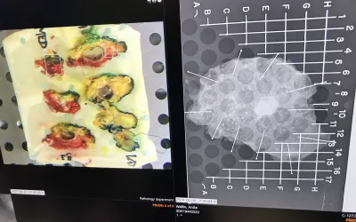 As enterprise imaging systems see expanded use by other departments in the hospitals beyond cardiology and radiology, digital pathology is the third largest large data user in these systems. This is an example of photo of specimens from a patient and a X-ray of one of the specimens shown by Sectra. #RSNA