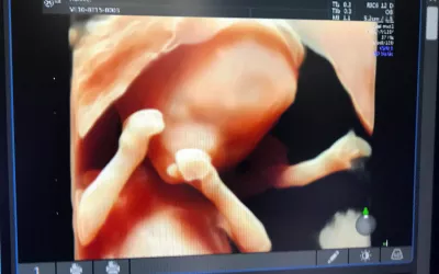 Example of 3D photo-realistic ultrasound technology at RSNA 2022. The simulated lighting source can be moved around to change the locations of the shadows. This makes for great portrait shots for the parents, but also allows physicians to better understand the relationship of anatomical structures if needed during fetal assessments. This is the HDlive rendering technology on the GE Voluson E10 system. Baby ultrasound images. Fetal imaging. Example of a baby ultrasound. Foetus ultrasound.