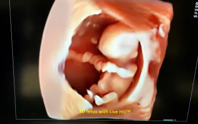 A 3D ultrasound fetal image showing the umbilical cord inside the amniotic sac. Image courtesy of Alpinion. Example of a baby ultrasound.