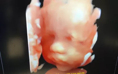 Fetal 3D ultrasound face shown by the vendor Alpinion. The company also OEMs its technology to some of the bigger vendors on the floor.  Fetal imaging. Example of a baby ultrasound. RSNA22 #RSNA. Foetus ultrasound.