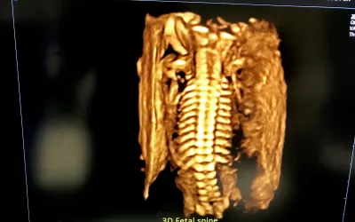 Fetal spine on 3D ultrasound. Image from Alpinion at RSNA 2022. Fetal imaging. Example of a baby ultrasound.