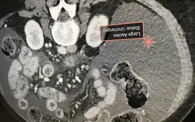 AI identification of live ascites using the AI Metrics technology. The AI was cleared by the FDA in December 2020.