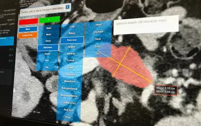 Pancreas on a CT automatically identified and countered from a CT scan by AI Metrics' cancer RECIST followup technology. The software can help[ call up prior serial exams and speed workflow when reviewing cancer treatment followup exams to see if treatments are affective. The AI can help reduce reproducibility issues between various radiologists. #RSNA