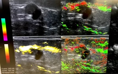 The new breast imaging modality of opto-acoustic ultrasound (OA/US) is explained at the Seno Medical booth at RSNA 2022. The technology uses 6 separate images to show the functional and anatomic features of breast tissue and immediately display features that differentiate tumor neoangiogenesis. this may prevent the need for additional testing or biopsy. The system just received U.S. FDA PMA clearance and the vendor celebrated with champaign being served in their booth. #RSNA
