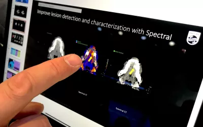 Example of how spectral CT can help detect a hard to see cancer in the skull. Example shown during a Philips Healthcare demo at RSNA 2022.
