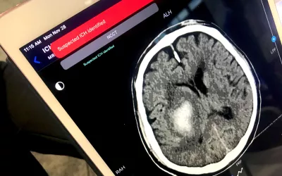 An example of artificial intelligence (AI) automated detection of a intracranial hemorrhage (ICH) in. a CT scan used to send alerts to the stroke acute care team before a radiologist even sees the exam. Example shown by TeraRecon at RSNA 2022.
