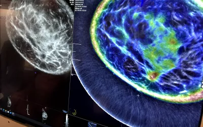 An example of the Delphinus whole breast ultrasound tomography technology. A ring transducer surrounding the breast creates an image of the whole breast, similar to MRI. It also uses reflection, sound speed and attenuation to characterize the tissue structure, as seen in the color-coded image, to help identify cancers.