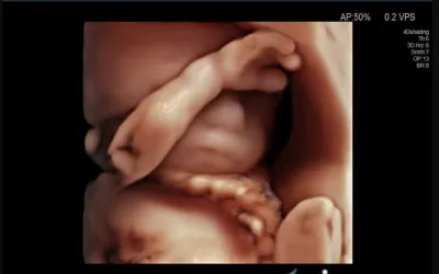 High definition 3D ultrasound of baby face. Image courtesy of Hitachi. Baby face on ultrasound on fetal imaging.