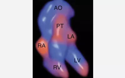 Four-dimensional “Glassbody” rendered image obtained in the Doppler cardiac spatio-temporal image correlation mode shows the fetal cardiac anatomy at 16 weeks gestation. Retrograde flow is in red, and antegrade flow is in blue. This type of view may help earlier diagnosis of congenital heart disease in fetal imaging. AO = aorta, LA = left atrium, LV = left ventricle, PT = pulmonary trunk, RA = right atrium, RV = right ventricle. Image courtesy of RSNA. Baby heart images, Fetal hart