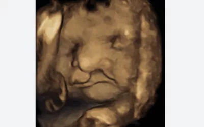 Example of a cleft lip detected on 3D fetal ultrasound. Image courtesy of RSNA. Example of a baby face ultrasound, fetal imaging.