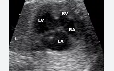 A congenital heart defect seen on a fetal ultrasound. The connection between the right and left ventricles is a ventricular septal defect (VSD), which can cause unoxygenated blood to be recirculated through the body. Image courtesy of RSNA. CHD VSD image. A VSD is also commonly called a "hole in the heart."