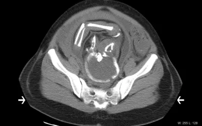 Axial computed tomography (CT) image of a third-trimester fetus. The patient was referred for CT by the emergency department because of right lower quadrant abdominal pain. Later-term pregnant patients often exceed the display field of view (arrows). The image shows a portion of the mother's hips and bottom of the spine (sacrum) and part of the baby's head and arm. CT is generally not used unless necessary on pregnant women because of concerns about ionizing radiation dose to the developing fetus. RSNA