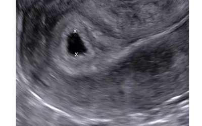 Early first-trimester ultrasound measurements to calculate the gestational age of the pregnancy prior to the embryo appearing in imaging. This is the average of orthogonal diameters of the gestational sac, measured from inner border to inner border. An intrauterine sac–like structure without a yolk sac or embryo, as seen in this example, is described as a probable intrauterine pregnancy. Follow-up ultrasound is performed at 14 days, at which time a live embryo should be visible. Images courtesy of RSNA. 