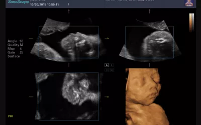 A standard view of a 3D fetal ultrasound exam, where 2D images are shown in the three standard imaging planes, each showing the same anatomy from a different angle, and a rendered 3D volume image. Sonographers and radiologists use the 2D images to make diagnosis and to take measurements. Baby ultrasound image courtesy of Konica-Minolta. Foetus ultrasound.