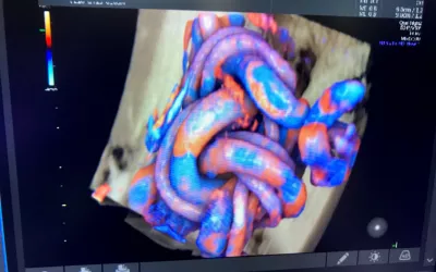 Umbilical cord tied into a knot from fetal movement seen on an 3D/4D ultrasound. The color coding shows the blood flow, which can help determine if the fetus is getting enough oxygen from the mother's blood supply. This is the HDlive rendering technology on the GE Voluson E10 system. Baby ultrasound photos. Fetal imaging. Example of a baby ultrasound.