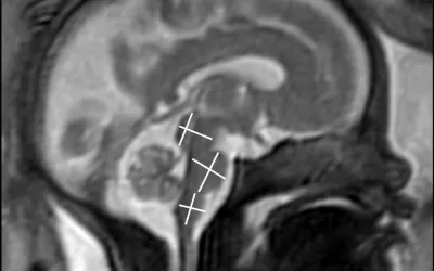 MRI image to assess fetal brain development. Image courtesy of RSNA. Baby brain on MRI. Fetal imaging.