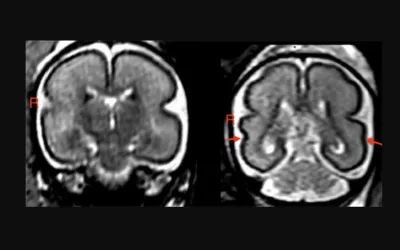 Alcohol consumption during pregnancy can change the unborn baby’s brain structure and delay brain development. Left: Fetal brain post-intrauterine alcohol exposure in fetus between 25 and 29 gestational weeks. Note the smooth cortex in frontoparietal and temporal lobes. Right: Brain of matched healthy control case in fetus between 25 and 28 gestational weeks. The superior temporal sulcus is already bilaterally formed (red arrows) and appears deeper on the right hemisphere than on the left. Image from RSNA
