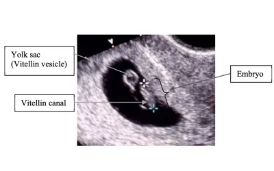 An explanation of first trimester transvaginal ultrasound showing the yoke sac and the embryo embedded on the edge of the uterine wall. Image courtesy of the Department of Global Health, University of Washington. Fetal imaging. Example of a baby ultrasound.