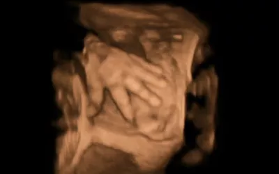 Fetal hand in a 3D ultrasound. Image courtesy of Hitachi. Baby hand photo on ultrasound. Fetal imaging. Example of a baby ultrasound. Foetus ultrasound.