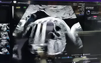 Assessment of the left ventricular outflow tract (LVOT) of the heart and aorta to look for congenital heart defect anomalies. A demo image from GE Healthcare at RSNA 2022. Fetal imaging. Example of a baby ultrasound.