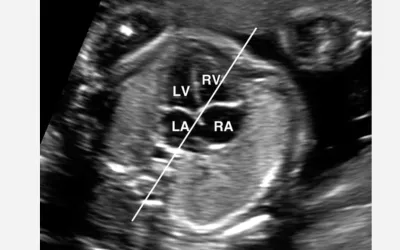 A standard four-chamber view of a fetal heart on ultrasound. The heart is examined to look for congenital heart disease (CHD), such as transposed vessels, connections between the chambers and defective heart valves. Image courtesy of RSNA