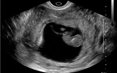 Transvaginal ultrasound of a fetus in early development during the first trimester. Baby ultrasound image courtesy of RSNA. Foetus ultrasound.