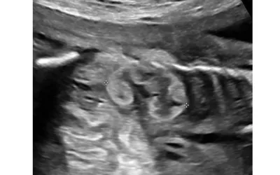 Ultrasound measurement of kidney length in a 23 week-old fetus. Renal measurements are one of several fetal anatomic structures that demonstrate consistent growth throughout the latter half of gestation, and measurements of these structures reliably correlate with gestational age (GA). This can be important in the second trimester and beyond as a more accurate measure of GA than body length. Image courtesy of RSNA. Baby, fetal clinical ultrasound images. What is measured on baby ultrasounds?