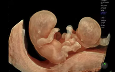 Twins seen in 3D fetal ultrasound. Image from GE Healthcare. Baby ultrasound images of twins. Foetus ultrasound.