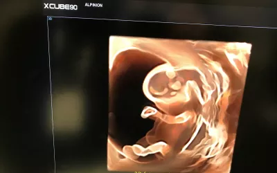 3D ultrasound of a fetus early in development. Image courtesy of Alpinion, Fetal imaging. Example of a baby ultrasound.