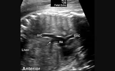 Fetal ultrasound evaluation of the vena cava connection into the right atrium of the heart to check for congenital heart abnormalities that merit referral for further evaluation. A similar evaluation will be performed on the aortic outflow tract of the heart to ensure there is normal anatomy. Image courtesy of RSNA. Baby ultrasound, fetal ultrasound images.