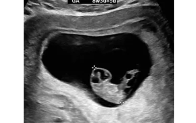 As a pregnancy advances, the embryo is easier to see, and accurate measurements can be obtained with transabdominal ultrasound. This ultrasound shows a crown-rump length (CRL) measurement with calipers. CRL is the average of discrete fetal measurements from the tip of the head end to the tip of the rump end in the midsagittal plane of the embryo. This is highly accurate for pregnancy dating in the first trimester. Images courtesy of RSNA. Fetal imaging. Example of a baby ultrasound.