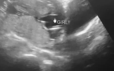 As a fetus develops, sonographers can identify the sex on ultrasound. This is an an example of the "hamburger" sign of the vagina, which looks like the two buns of a hamburger or an equal sign. Males are identified by the "turtle" sign, where the genitalia look like a small turtle, or a turtle's head poking out.  How to determine sex in fetal ultrasound. It's a girl! Baby ultrasound. Baby girl ultrasound. 