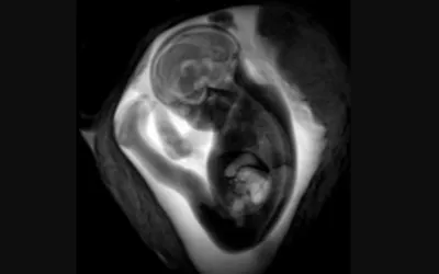MRI of a fetus inside the mother. Image courtesy of RSNA. Fetal, baby imaging. Example of a baby MRI.