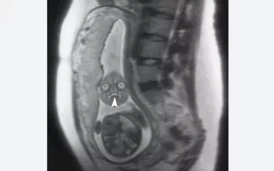 An MRI of a fetus inside the mother. The freakish appearance of the eyes and the face are normal for MRI fetal imaging. Image courtesy of RSNA. Baby MRI, baby ultrasound