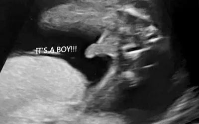 As a fetus develops, sonographers can identify the sex on ultrasound. This is an an example of the "turtle" sign, where the genitalia looks like a small turtle, or a turtle's head poking out. Females can be identifed by the "hamburger" sign of the vagina, which looks like the two buns of a hamburger or an equal sign. How to determine sex in fetal ultrasound. It's a boy! Baby ultrasound